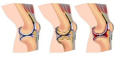 Étapes de développement de l'arthrose de l'articulation du genou