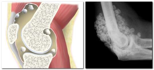 chondromatose avec douleur dans l'articulation de la hanche